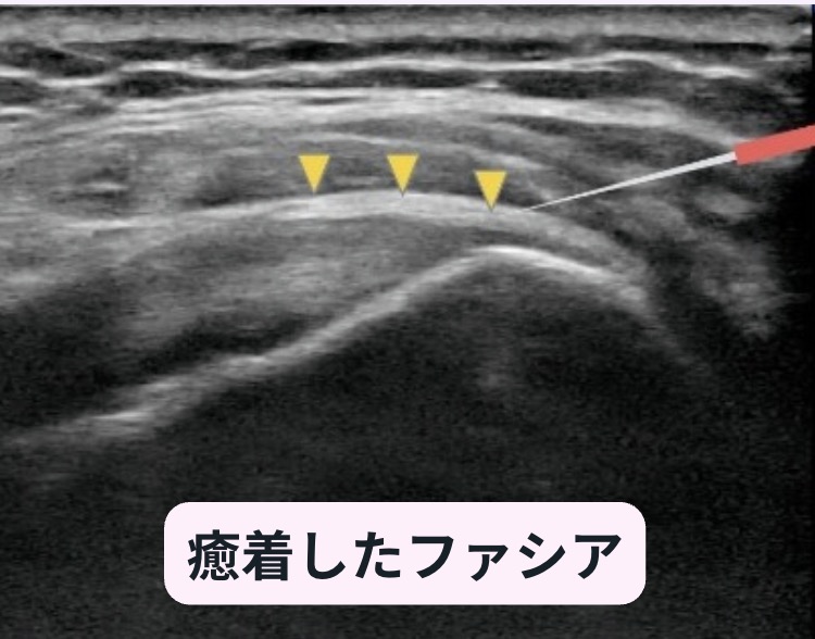 癒着したファシアのエコー画像