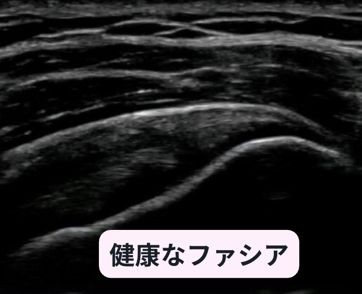 健康なファシアのエコー画像